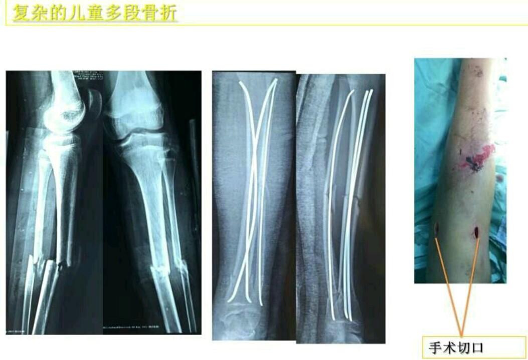 邱医生手术,邱医生祛疤