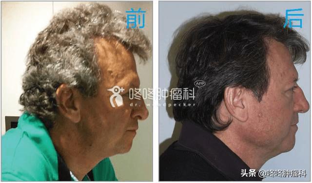 pd-1最常见副作用,pd-1奇葩副作用