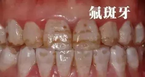 11个月牙齿脱矿龋齿如何补救,龋齿脱矿用含氟牙膏多久有效果