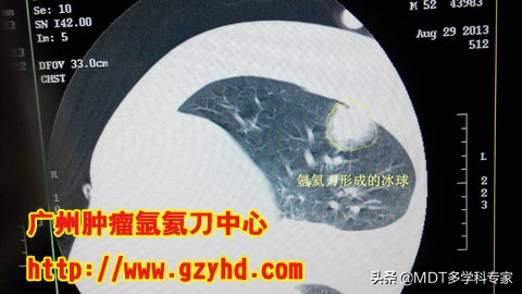 肺癌可以做微波消融术,肺结节肺癌可以吃中药调理吗