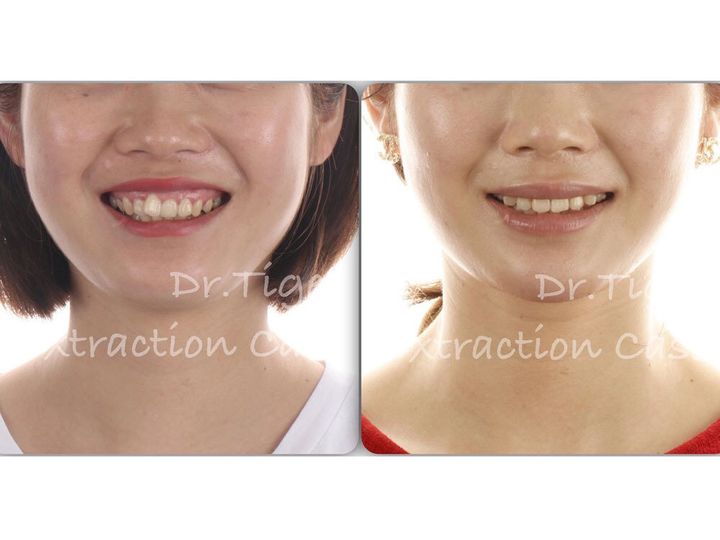 南京靠谱的牙齿矫正医院,南京省哪个医院牙齿矫正比较好