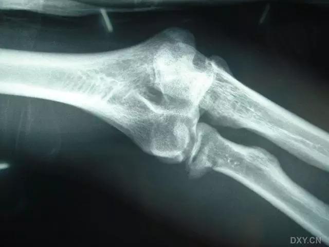 所有骨折都叫什么名字,骨折的名称有哪些