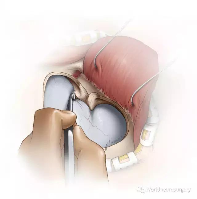 翼点入路技巧图解,翼点入路的开颅要点