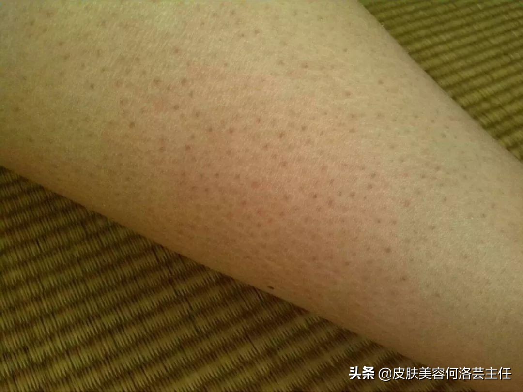 戴口罩闷痘怎么办,戴口罩闷痘皮肤差如何正确护肤