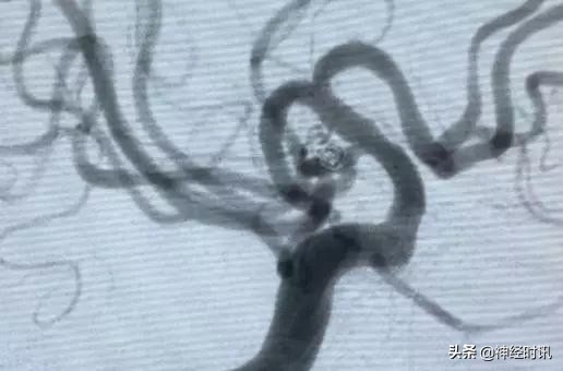 脑血管病介入治疗的介绍,缺血性脑血管病介入治疗进展2015