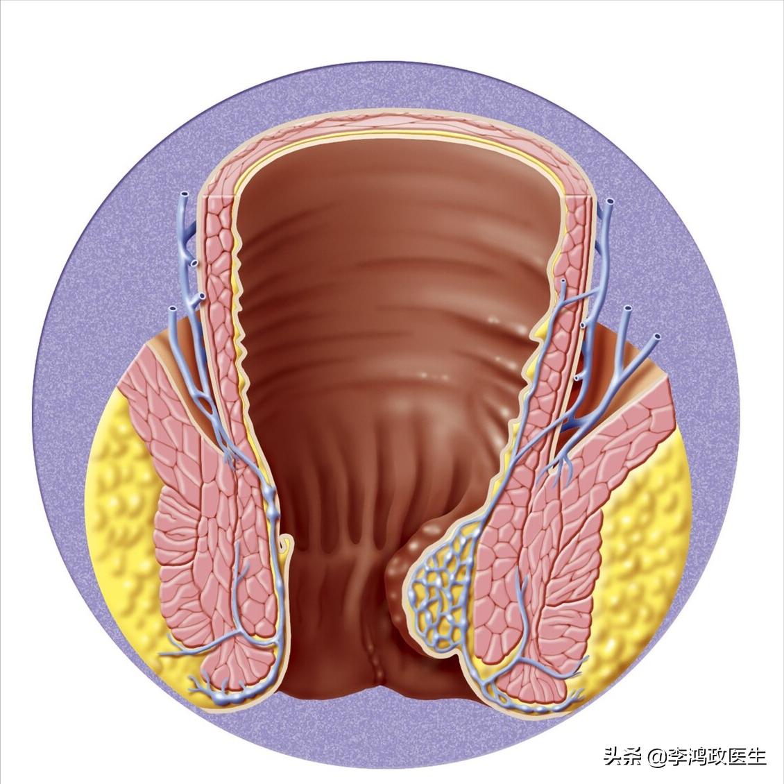 男子屁股痒,肛门瘙痒痔疮需要做肠镜吗