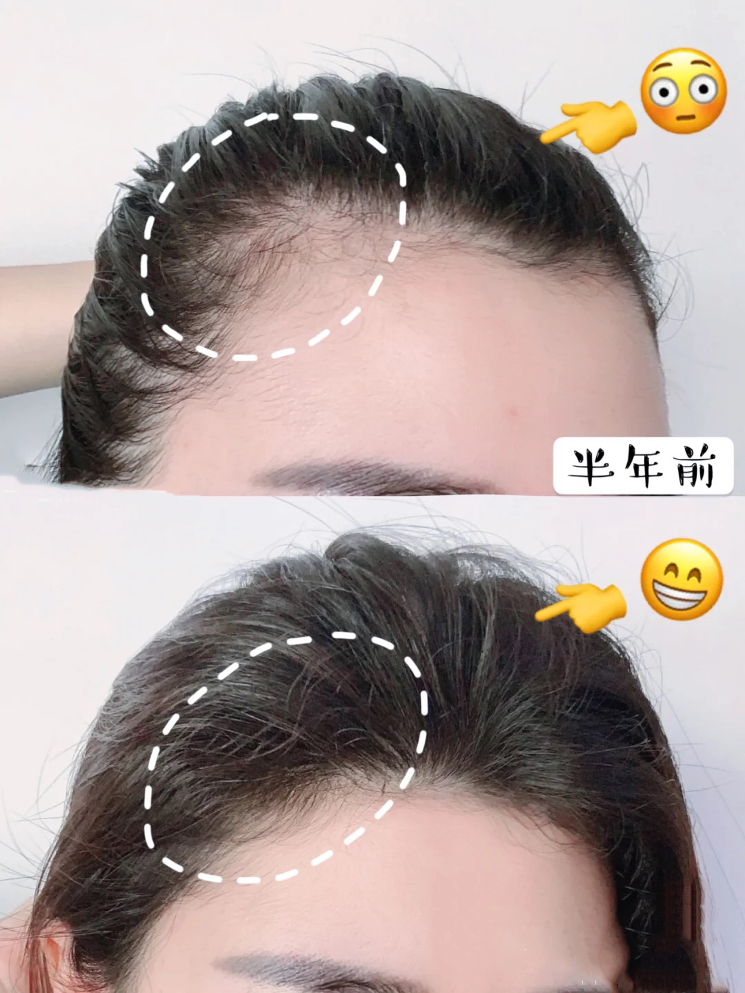 严重自来卷前额碎发巧妙处理,如何做到不秃头