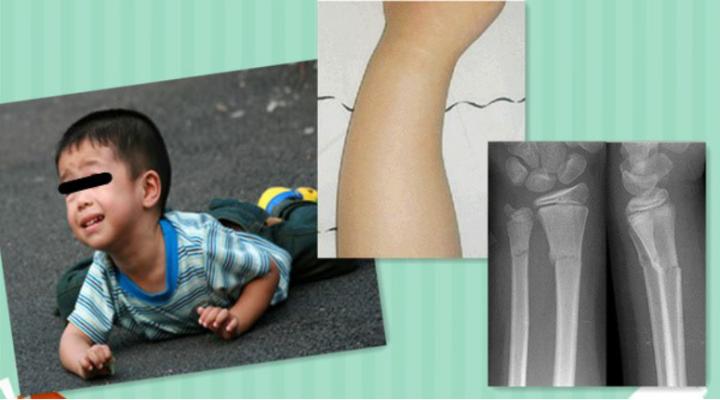 带你了解骨科术后康复,骨科早期康复介入