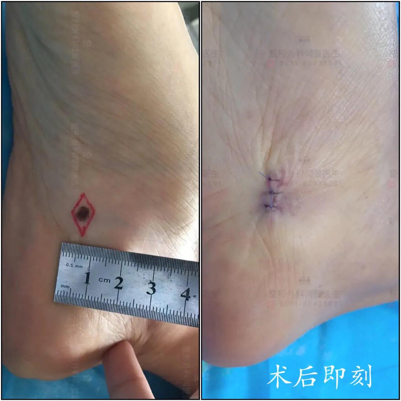 脚底有痣激光还是手术切除,黑色素痣手术切除还是激光去除好
