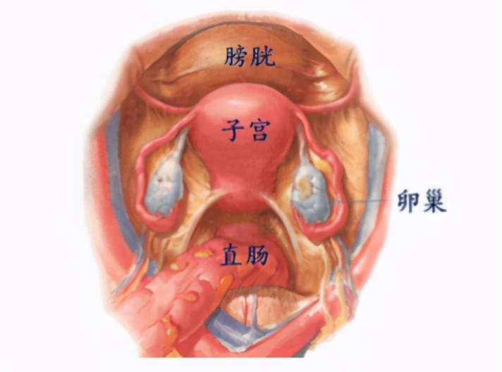 体检突然发现子宫肌瘤,发现子宫肌瘤怎么办