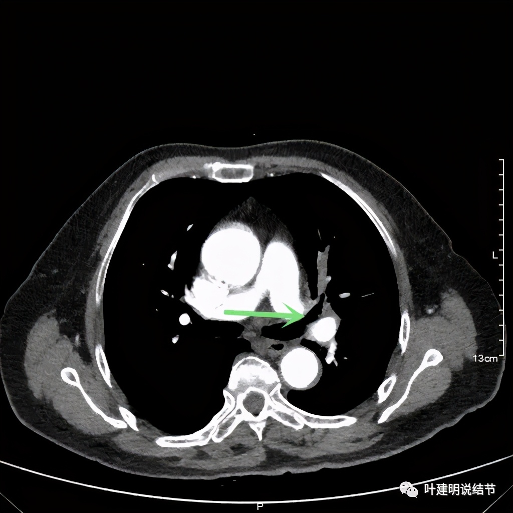 卡瑞利珠单抗治疗肺鳞癌有用吗,特瑞普利单抗对鳞癌治疗有效吗