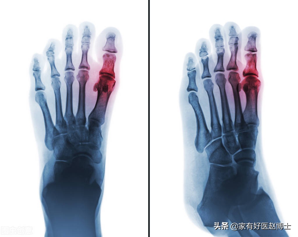 血脂血压尿酸都高如何治疗,血压血脂血糖尿酸哪个更严重