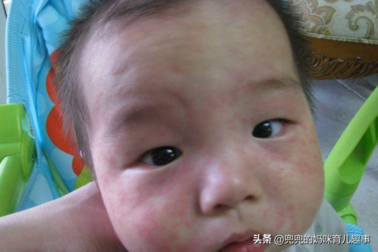 1岁宝宝发烧三天后出现红疹子,1岁宝宝发烧后身上起红疹怎么办