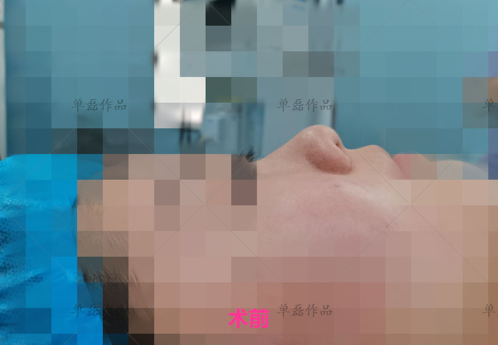 膨体隆鼻科普及优势介绍,膨体隆鼻和肋骨哪个更好