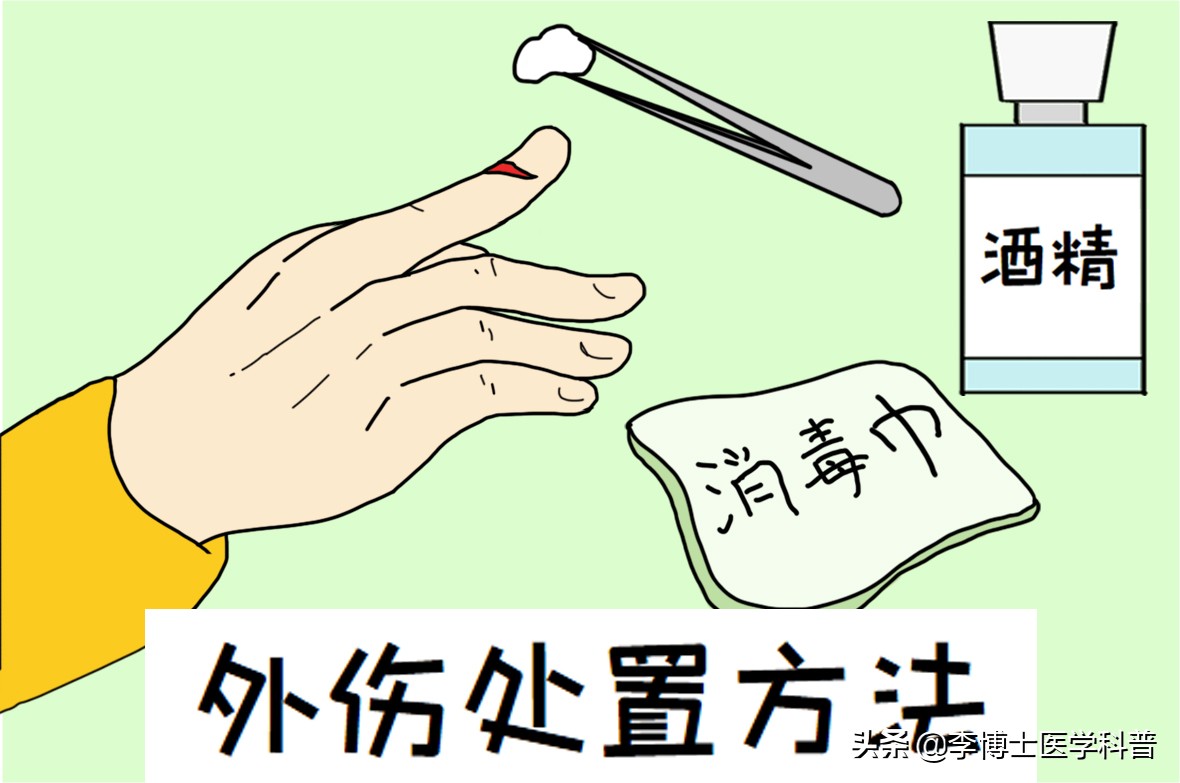 手外伤撕裂恢复最佳方法,手外伤的急救处理与断指的保存