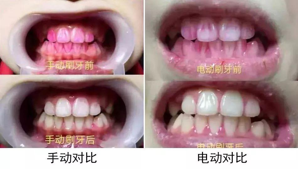 电动牙刷比手动的刷牙效果好吗,儿童电动牙刷好还是手动牙刷好