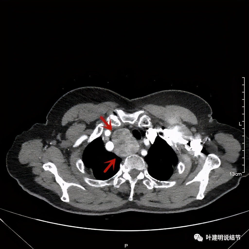 胸部高分辨ct检查注意事项,胸部ct扫描有没有危害