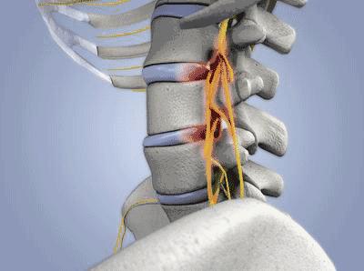 小针刀治疗颈椎病隔几天扎一次,小针刀治疗颈椎病可靠吗
