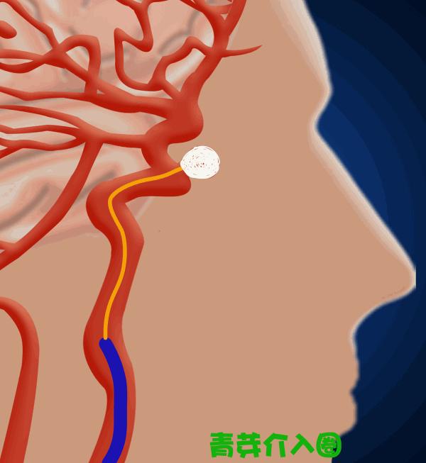 颅内动脉瘤介入栓塞支架全过程,颅内夹层动脉瘤介入演示