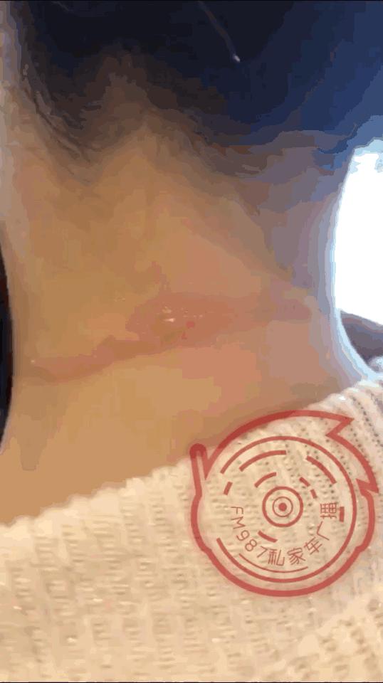 福州一女子进店美发,竟遭滚烫蒸汽喷射……疤痕吓人!