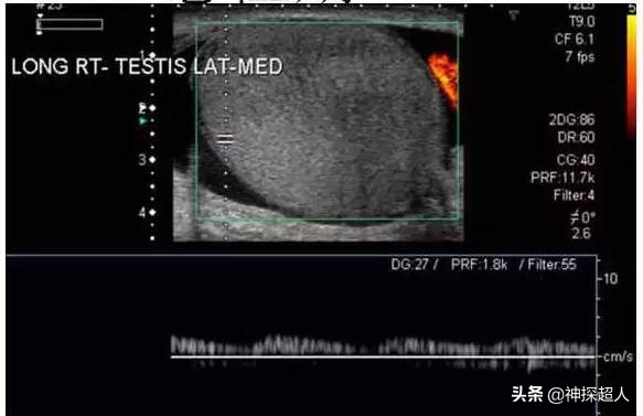 男性“蛋蛋”痛,必须引起重视,特别是一侧突发痛