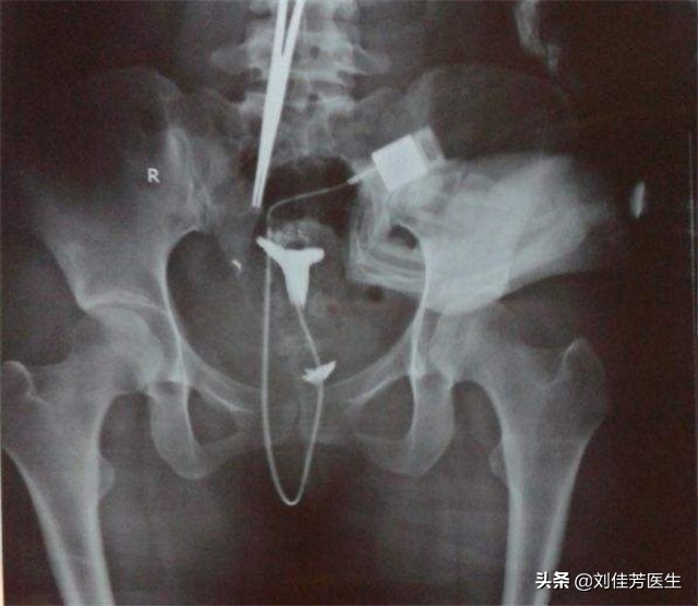 疏通输卵管堵塞的最佳时间和方法,出现输卵管堵塞怎么疏通最快