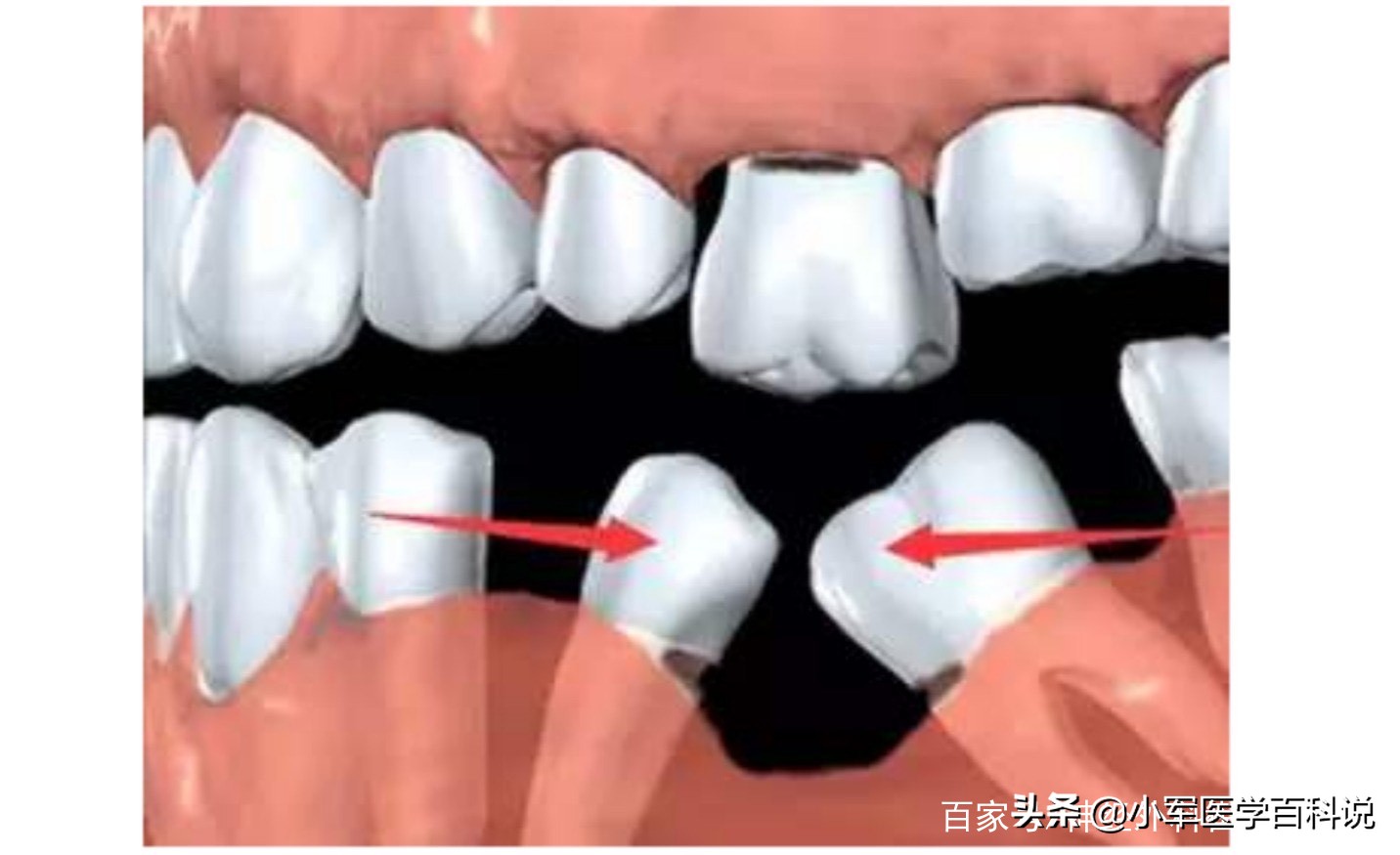 成年人牙齿破损还能长吗,成人牙齿坏了只剩牙根