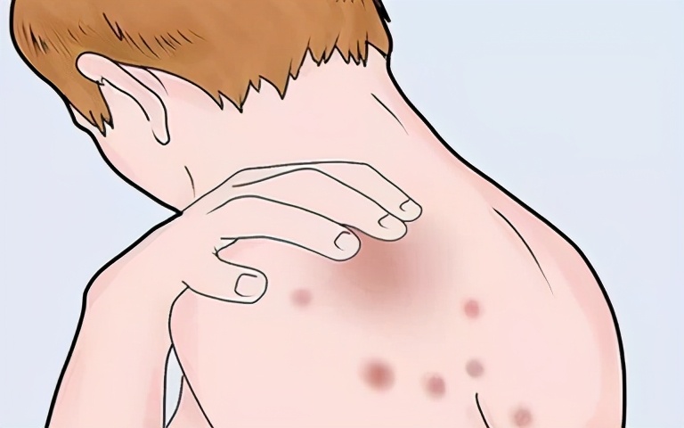 宫颈癌放疗的副作用如何缓解,宫颈癌放疗的副作用怎么缓解