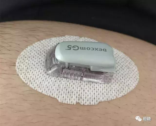 闭环式胰岛素泵会低血糖吗,闭环胰岛素泵使用寿命