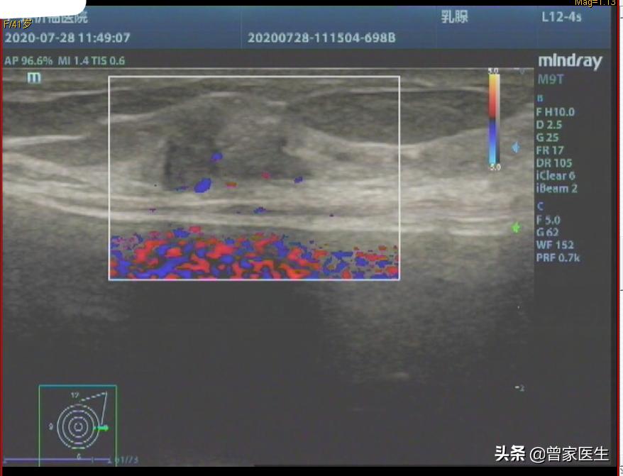 乳腺彩超4a报告单怎样描述的,乳腺彩超birads4a类严重吗