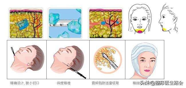 去除双下巴和颈部脂肪手术,手术去除下巴赘肉最有效的方法