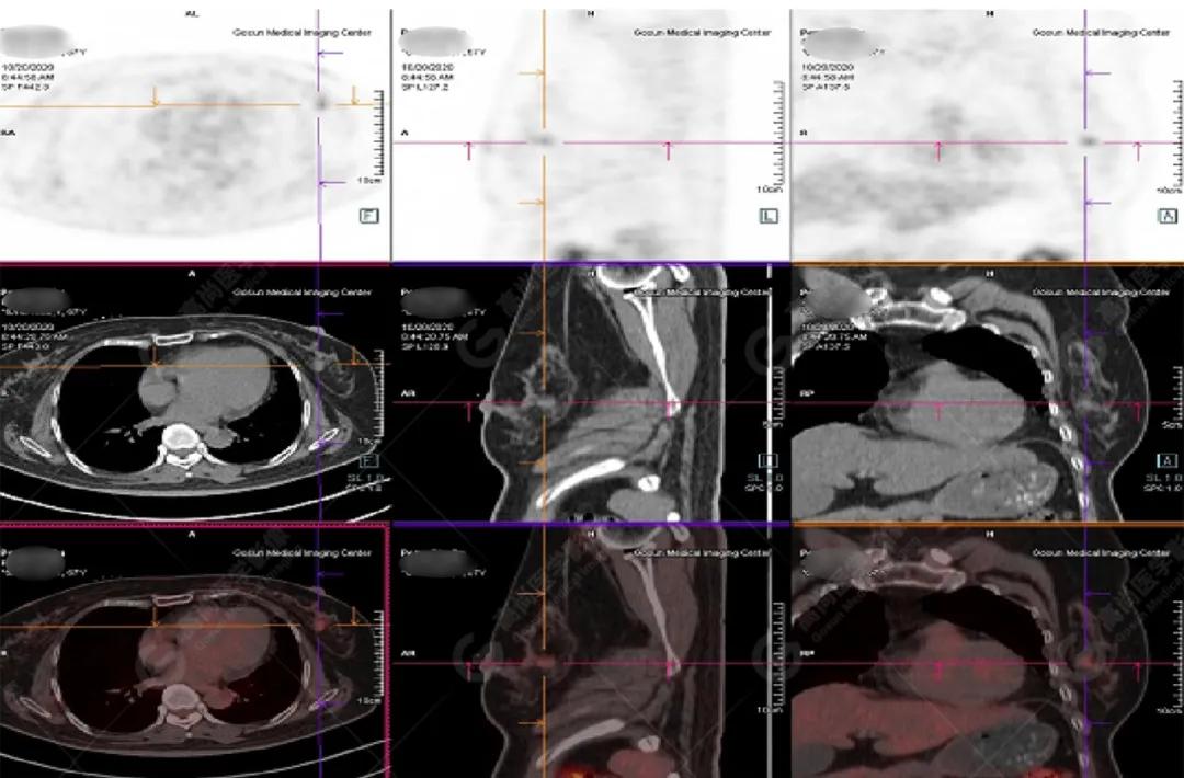女性防癌检查科普,妇女宫颈癌及乳腺癌筛查情况年报