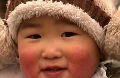 冬季寒冷干燥，不想娃的脸变成“红苹果”，这些护理父母要知道