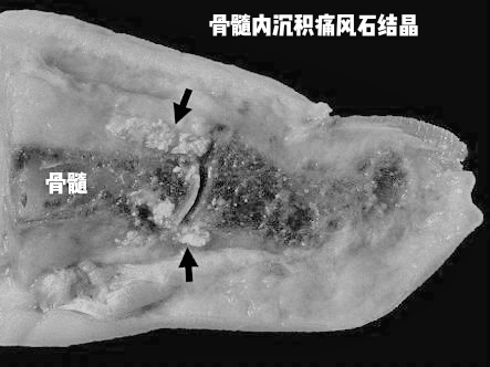 关节炎辟谣,膝关节滑膜炎辟谣