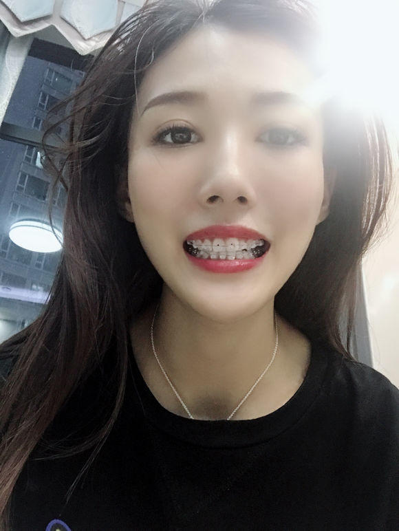 牙套日记一年级,牙套日记在线观看