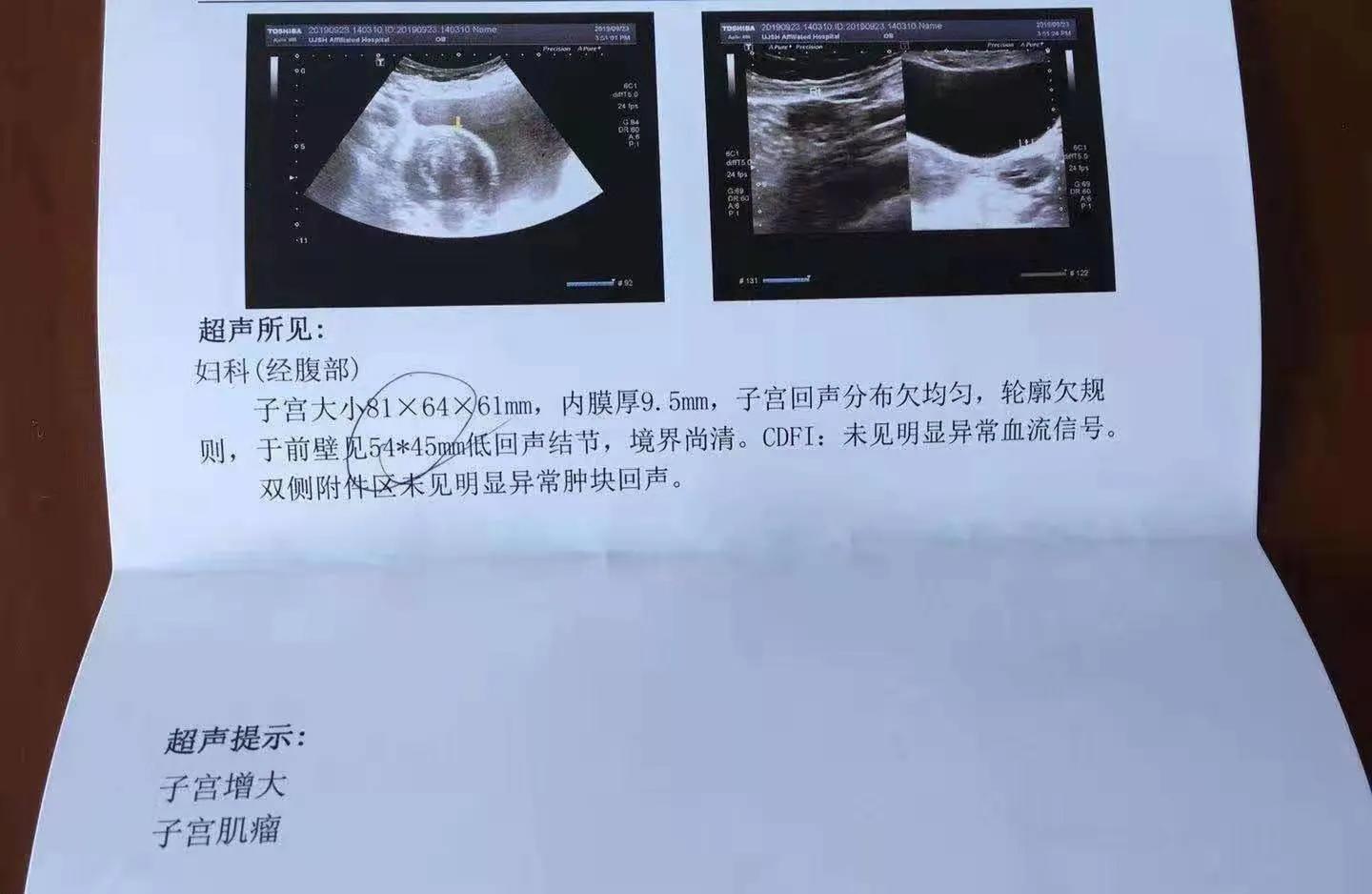 鸡蛋大小的子宫肌瘤能消除吗？