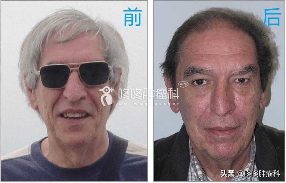 pd-1最常见副作用,pd-1奇葩副作用