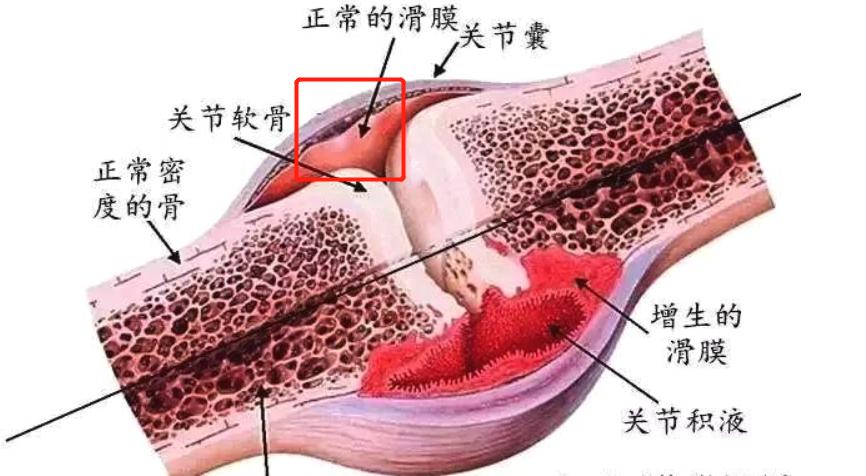 膝盖有滑膜炎,还能治愈吗?该怎么办?不想手术,3个要点需牢记