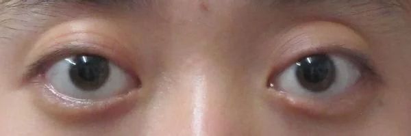 近视眼手术死鱼眼,近视手术可以改善眼球突出吗