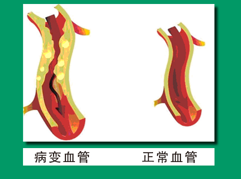 做造影血管堵50%要紧吗,心脏血管造影手术后血管还会堵吗