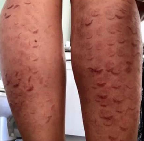 加拿大女子被烧伤,温哥华妹子花7000加币激光脱毛