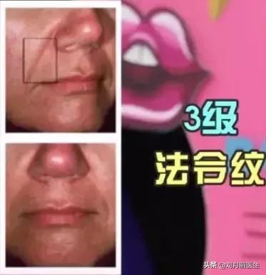 消灭法令纹护肤大法,如何正确嘟嘴消灭法令纹
