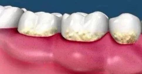 刷牙草草结束，不认真刷，最后可能就会变成这样子