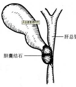 微创胆囊切除后伤口多久彻底愈合,胆囊切除是小手术吗