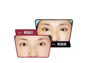 两眼间距宽割双眼皮,双眼皮割宽了还可以做修复吗