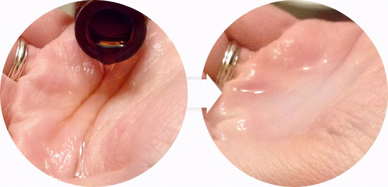 为什么抬头纹显得人这么老,多年的抬头纹怎么解决