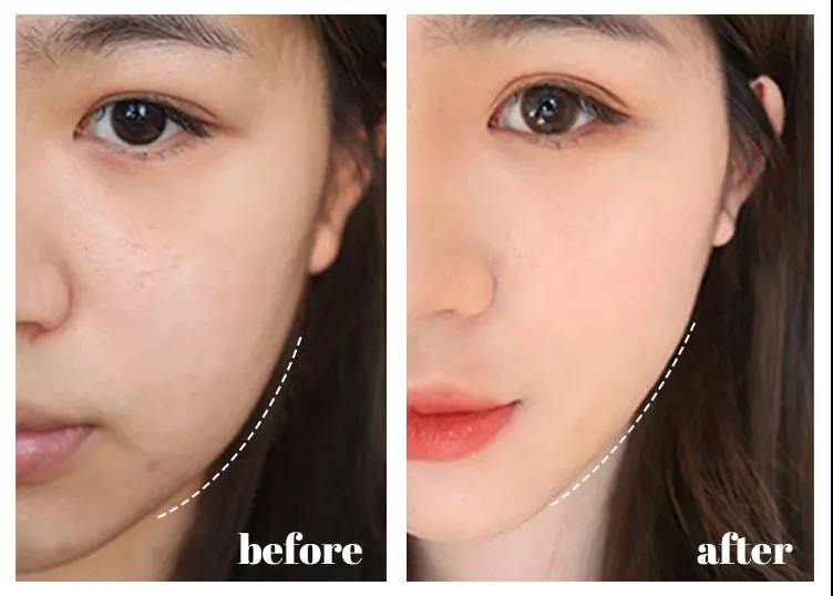 蜂毒面膜敏感肌肤,肌肤下垂松弛如何改善