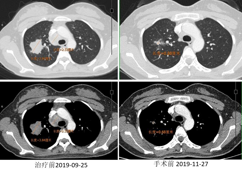 PD-1新辅助治疗初探，典型案例汇总一览