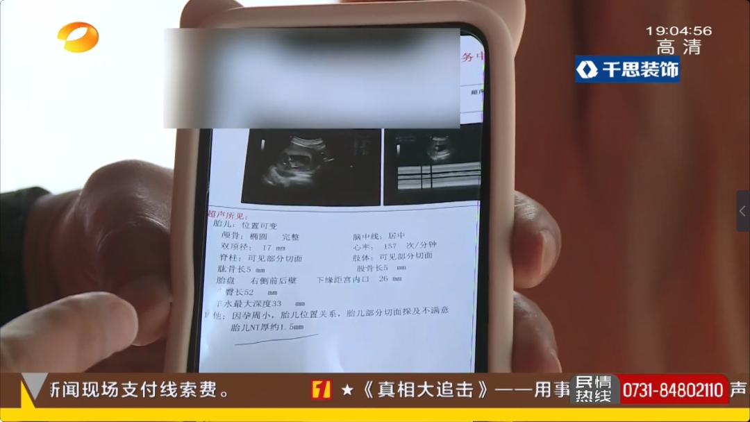 隆鼻后怀孕假体外露,女子怀孕鼻子假体外露