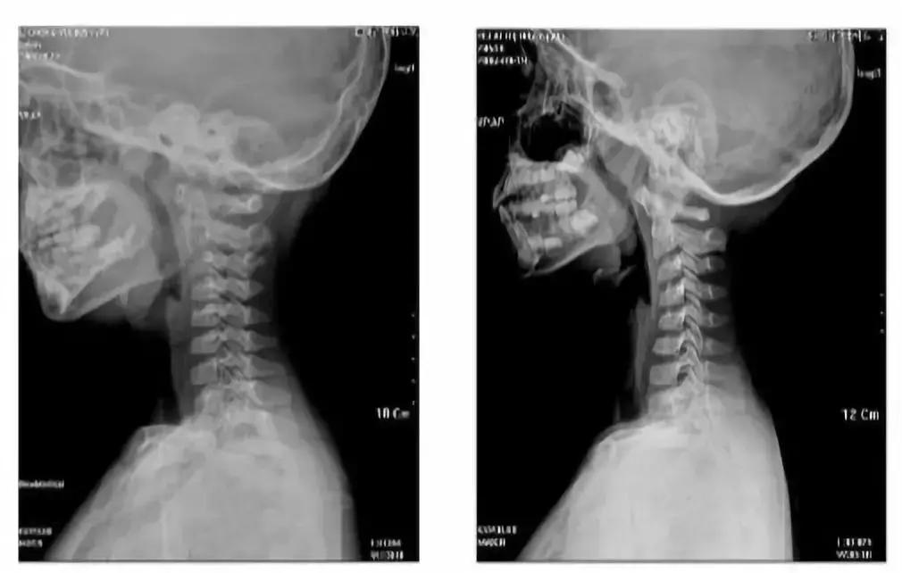 “减负”太遥远,现在我只想保住孩子的颈椎
